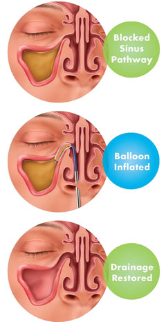 BalloonSinuplasty
