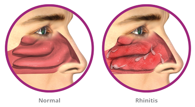 Normal vs Obstructed